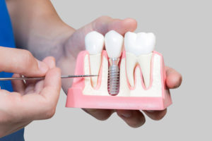 Dental Assistant Showing Off A Dental Implant In A Jawbone Cutaway Model in Prairieville, LA