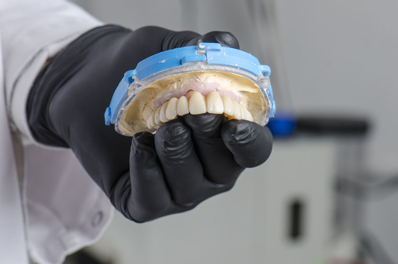 a picture of a doctors gloved hand holding a full mouth dental implant prosthetic before placing it in a patients mouth.