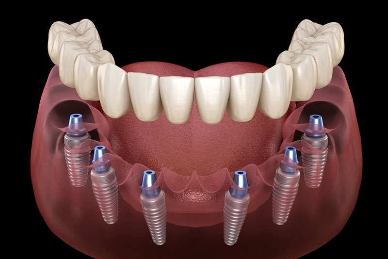a full mouth dental implant model that shows patients how they can have a customized new smile with the dental implants strategically placed in the gums, the abutments, and the prosthesis on top.