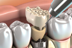 model of a bone grafting and dental implant procedure.