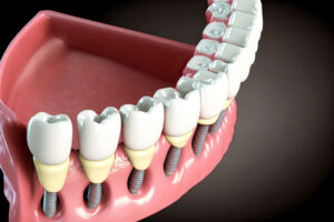 Close-up 3d model of a dental implant